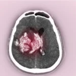 সেরিব্রাল কনটিউশন এবং ইন্ট্রাসেরিব্রাল হেমাটোমা