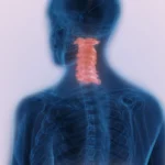 সার্ভিকাল মেরুদণ্ডের অবক্ষয়জনিত ব্যাধি