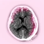 এপিডুরাল হেমাটোমা