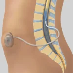 ইন্ট্রাথেকাল ব্যাক্লোফেন পাম্প