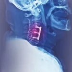 অক্সিপিটোসার্ভিকাল জংশন অস্থিরতা