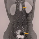 মেরুদণ্ডের টিউমার