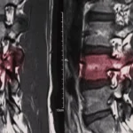 মেরুদণ্ডের হাড় ভাঙা