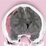 তীব্র সাবডুরাল হেমাটোমা