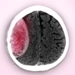 দীর্ঘস্থায়ী সাবডুরাল হেমাটোমা