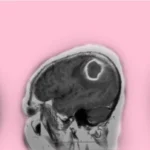 টিউমার বা রক্তনালী ত্রুটির কারণে মৃগীরোগ