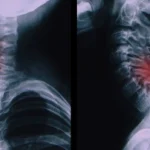 শিশুদের মেরুদণ্ডের হাড় ভাঙা