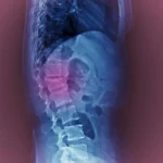 মেরুদণ্ডের সংকোচনের ফ্র্যাকচার