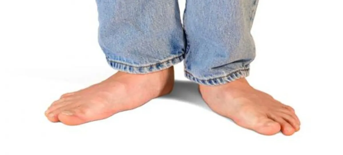 ما هي القدم المسطحة وكيف يمكن علاجها؟